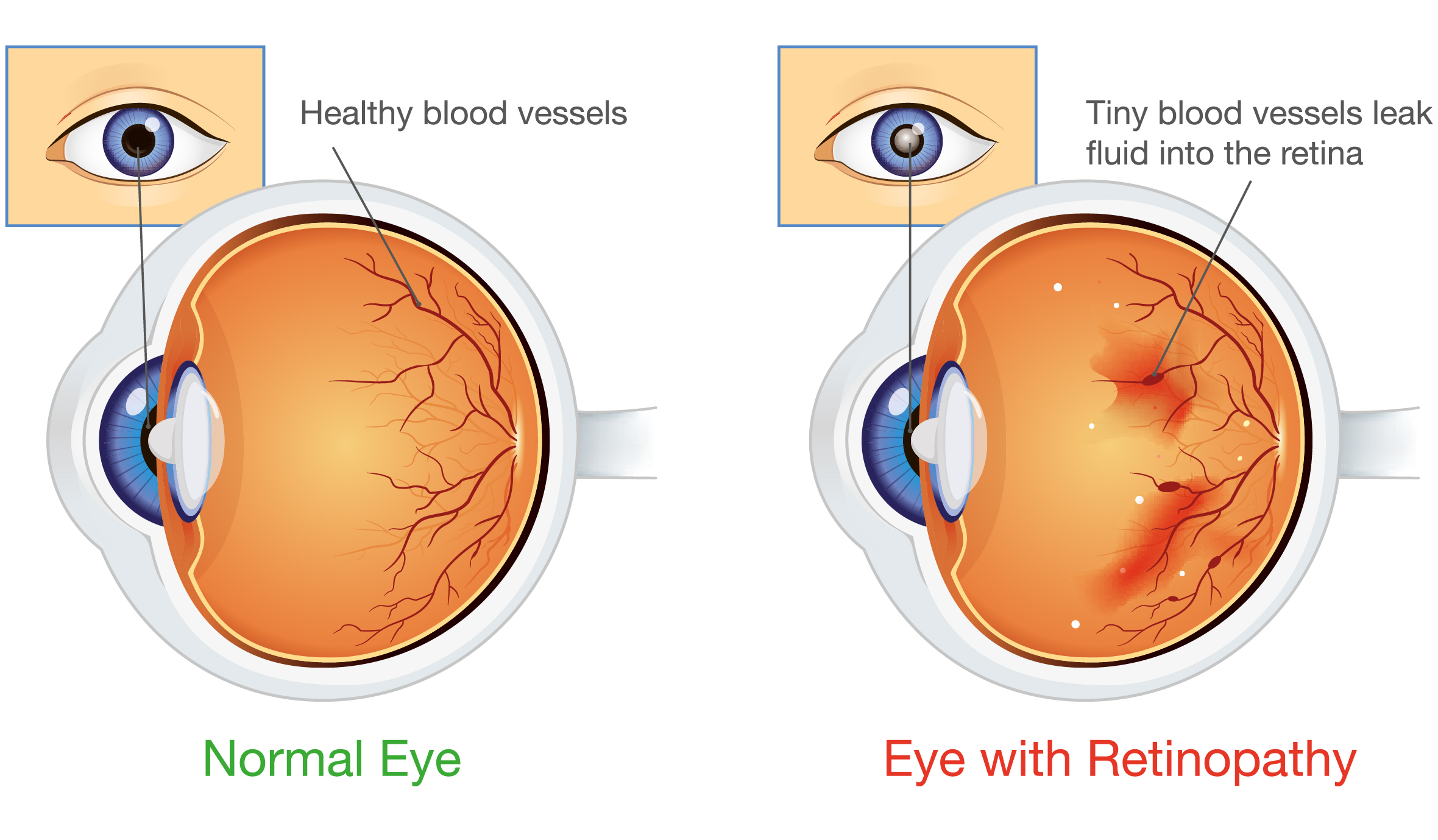 Diabetic Retinopathy & Eye Screening   Diabetes Education ...